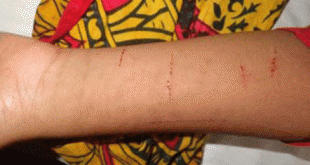 বীরগঞ্জে বখাটের ব্লেডের আঘাতে ৫ম শ্রেণির ছাত্রী হাসপাতালে