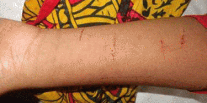 বীরগঞ্জে বখাটের ব্লেডের আঘাতে ৫ম শ্রেণির ছাত্রী হাসপাতালে